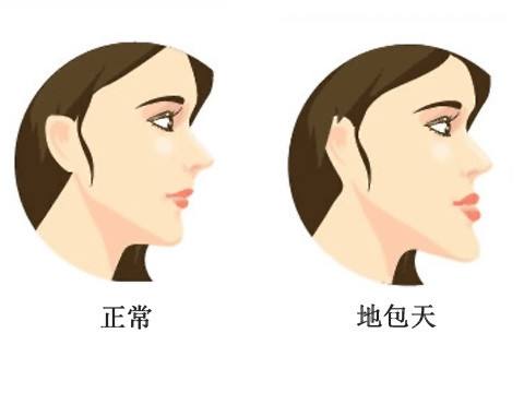 什么是地包天？地包天長什么樣子？地包天牙齒圖片