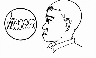 什么是地包天？地包天長什么樣子？地包天牙齒圖片